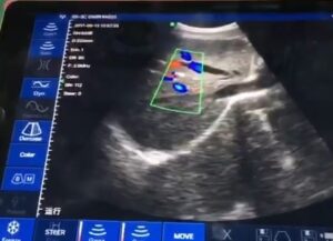 Color Doppler ultrasound scanner-SCAN-RESULT
